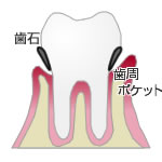 歯周病経過２